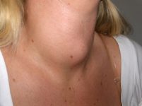 Hypertrophie cellulaire