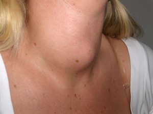 Hypertrophie cellulaire