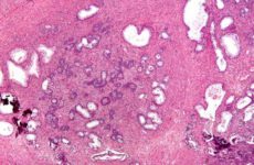 Hyperplasie nodulaire
