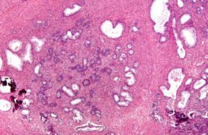 Hyperplasie nodulaire