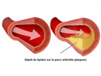 Colles - Dépôt de lipides