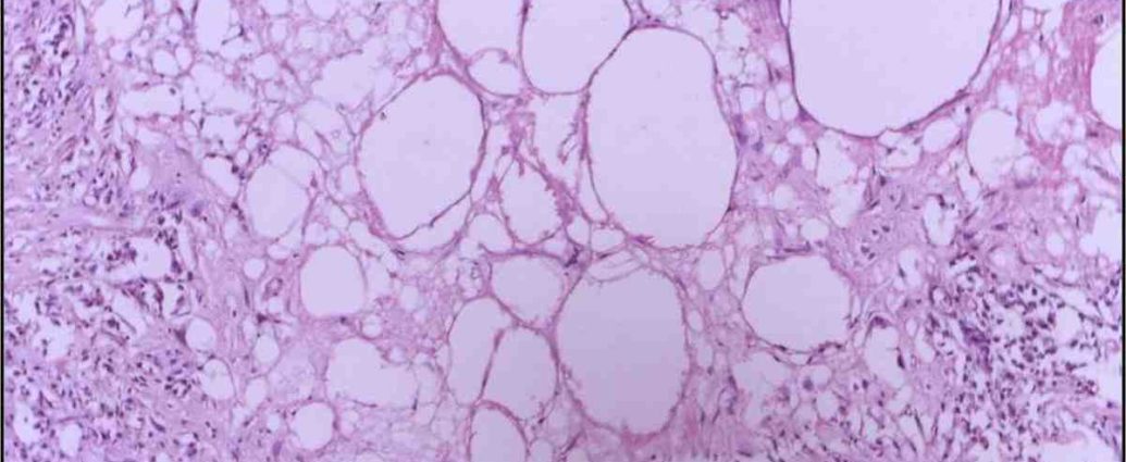Nécrose cellulaire