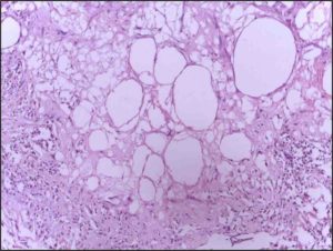 Nécrose cellulaire
