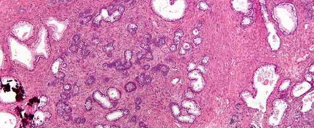 Hyperplasie cellulaire