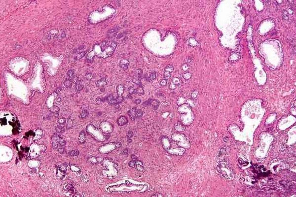 Hyperplasie cellulaire