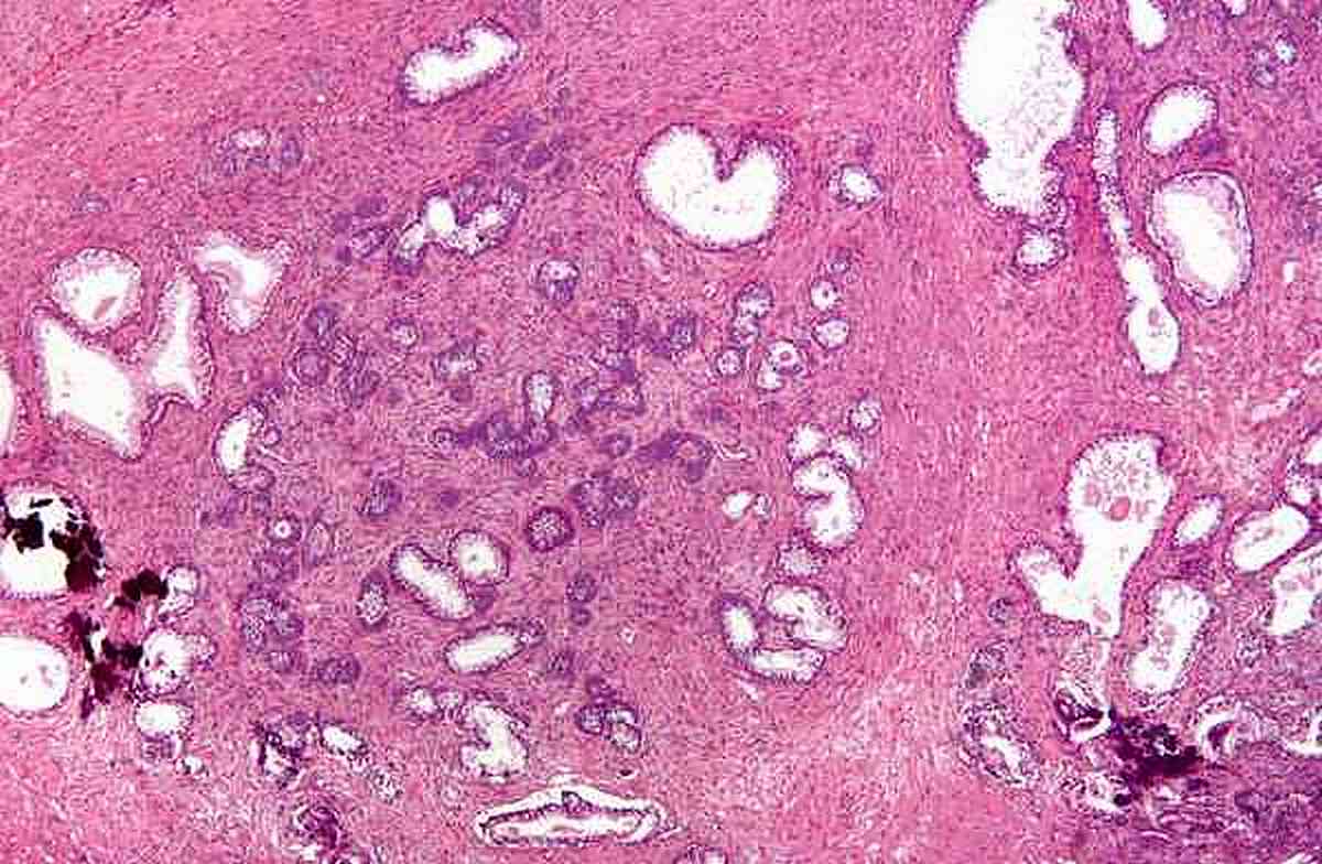 Hyperplasie cellulaire