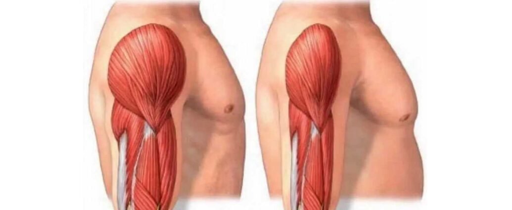 Atrophie musculaire