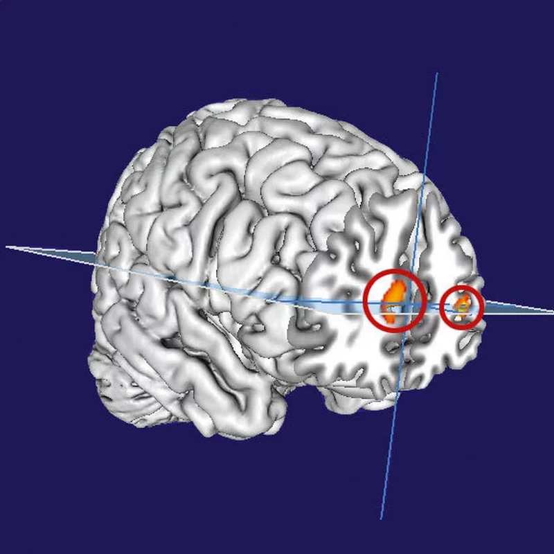 Siège du rêve lucide dans le cerveau