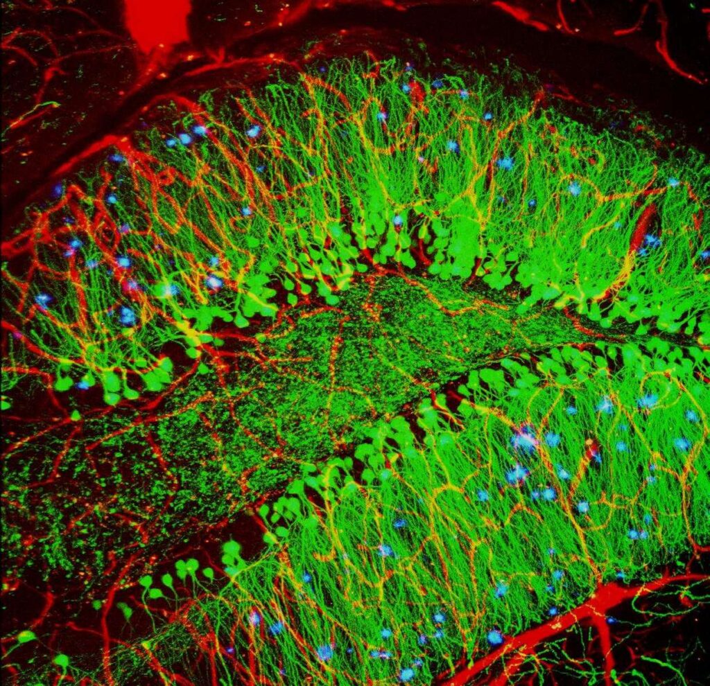 Alzheimer