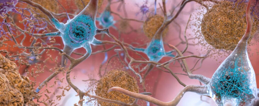 Plaques bêta-amyloïdes et Tau dans le cerveau