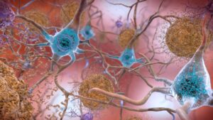 Liens étroits entre les virus et la maladie d’Alzheimer semblent se confirmer Plaques bêta-amyloïdes et Tau dans le cerveau