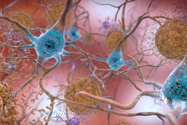 A32- Alzheimer Plaques béta-amyloïdes et Tau dans le cerveau, Flickr, by NIH Image Gallery, Public Domain