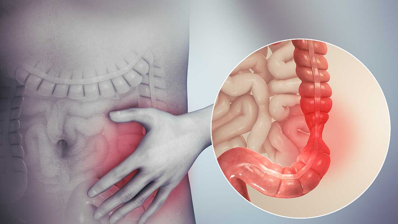 Inflammation intestinale